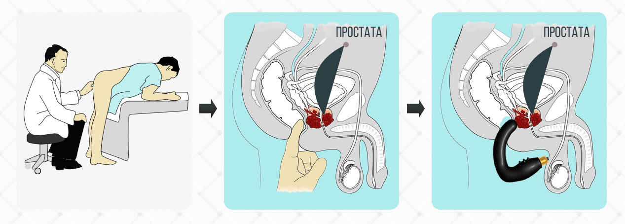 tratamentul prostatitei diadens dozarea gentomicinei pentru prostatita