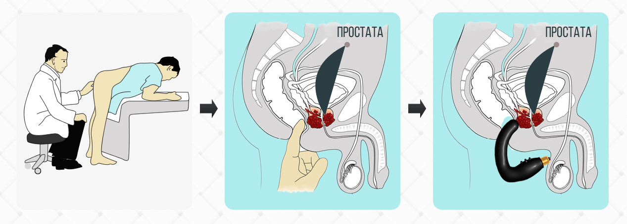 prostatita maestru om